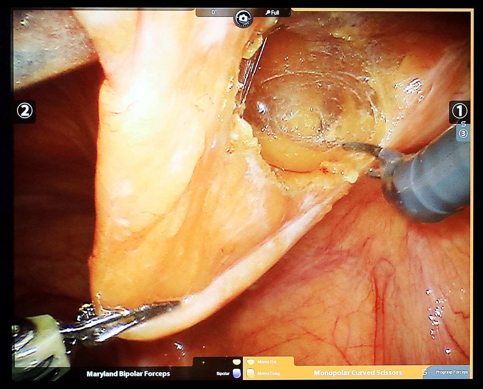 Robotic surgery